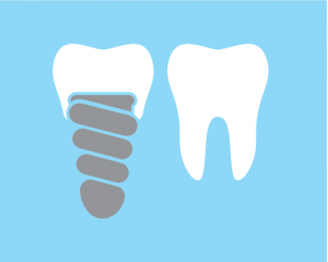 dental implant